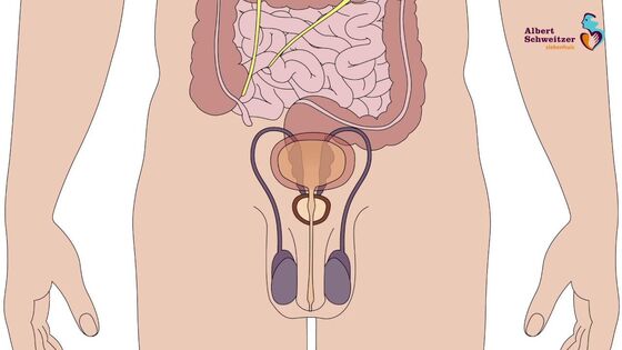 Blaasverwijdering en het aanleggen van een stoma