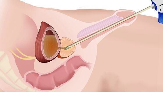 Urolift verhelpt plasproblemen bij een vergrote prostaat