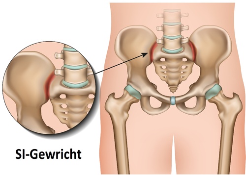 Lage rugpijn (uitgaande van het SI-gewricht) | Albert Schweitzer ziekenhuis | Pijnbehandelcentrum