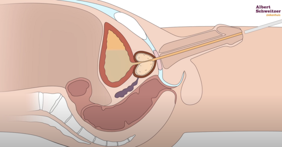TUR-Prostaat: het verwijderen van prostaatweefsel bij plasproblemen