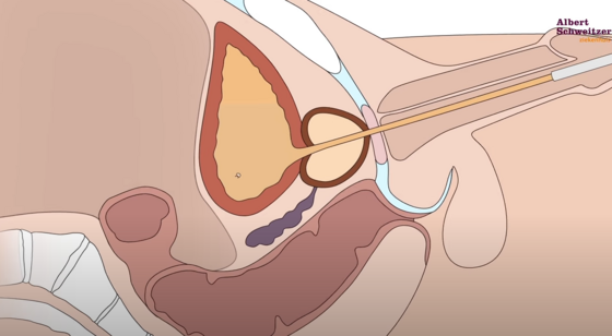 TUR-Blaas: het verwijderen van een poliep uit de blaas