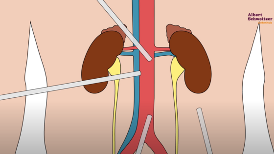Verwijderen van een nier via een kijkoperatie